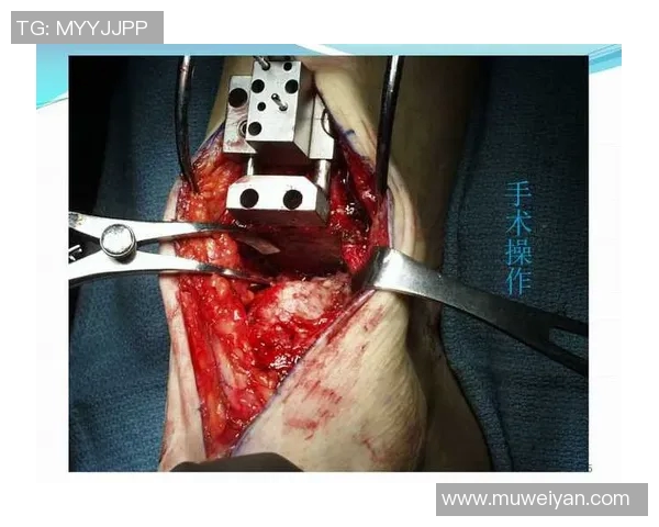 足球明星踝关节置换手术背后的故事与康复之路探秘